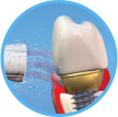 Clean and floss dental implants
