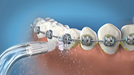 How to floss with braces