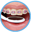 Best Waterpik for dental braces