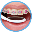 Best Waterpik™ for dental braces