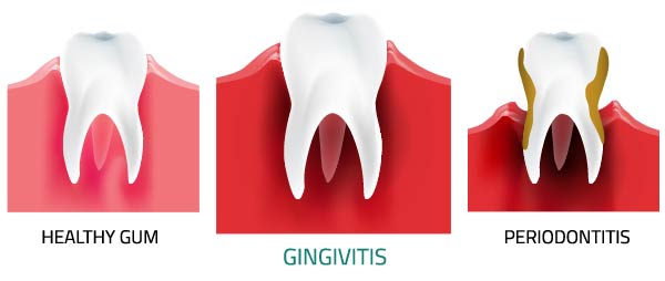 Pregnancy Gingivitis - treatment, symptoms, causes