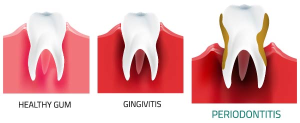 Periodontitis - treatment, symptoms, causes