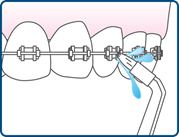 Move the flosser tip around the braces and along the teeth and gums