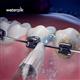 Using WOD-2E Whitening Orthodontic Tips 