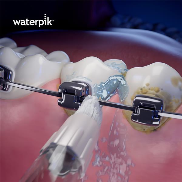Using WOD-2E Whitening Orthodontic Tips 