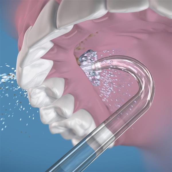 Using the Waterpik Implant Tip on the Upper Arch