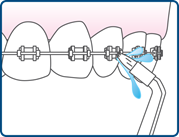 Déplacer l'embout de la hydropulseur dentaire autour des broches et le long des dents et des gencives