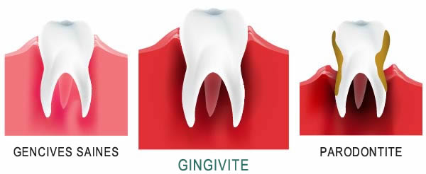 Gingivite - Symptômes, Causes & Traitement 