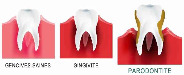 Parodontite - Symptômes, Causes & Traitement