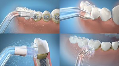 Embouts pour Hydropulseur Waterpik™